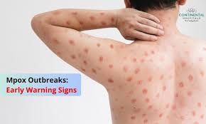 صورة توضيحية للجدري