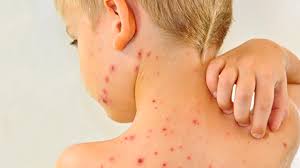 صورة توضيحية للحصبة