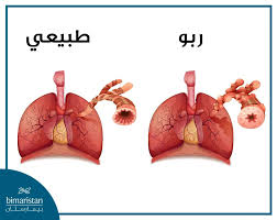 صورة توضيحية للربو